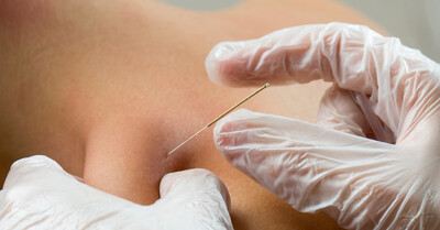 Close-up of a licensed healthcare professional performing dry needling therapy on a patient’s shoulder to relieve muscle tension, improve mobility, and reduce pain.