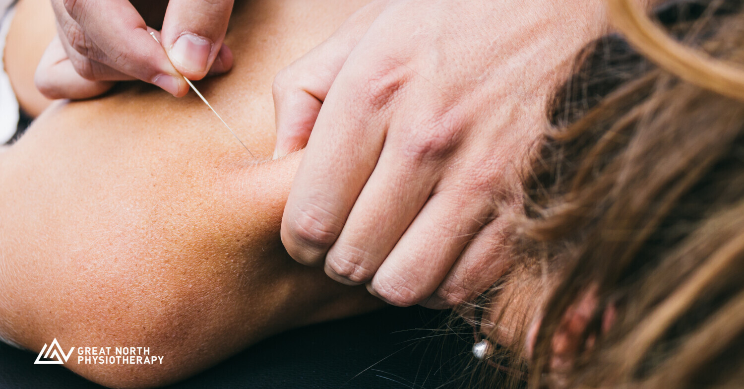 Physiotherapist performing intramuscular stimulation (IMS) dry needling treatment on shoulder muscle at Great North Physiotherapy in Niagara